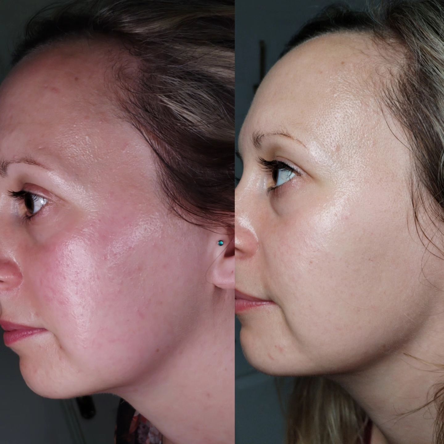 Facial Treatments